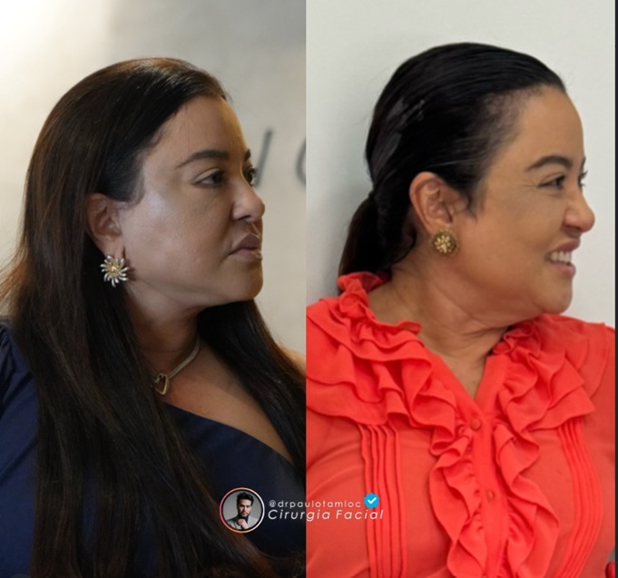 Bichectomia antes e depois